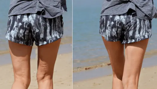 Why Does Cellulite Occur?