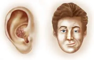 What is Ramsay Hunt Syndrome