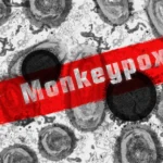 The Best-Known Effects of Monkeypox